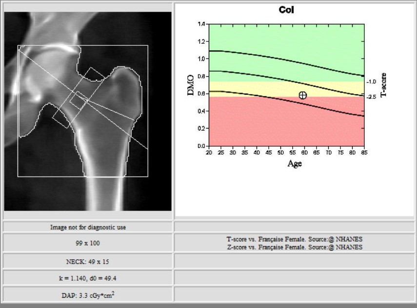  Ostéo densitométrie images d'examen