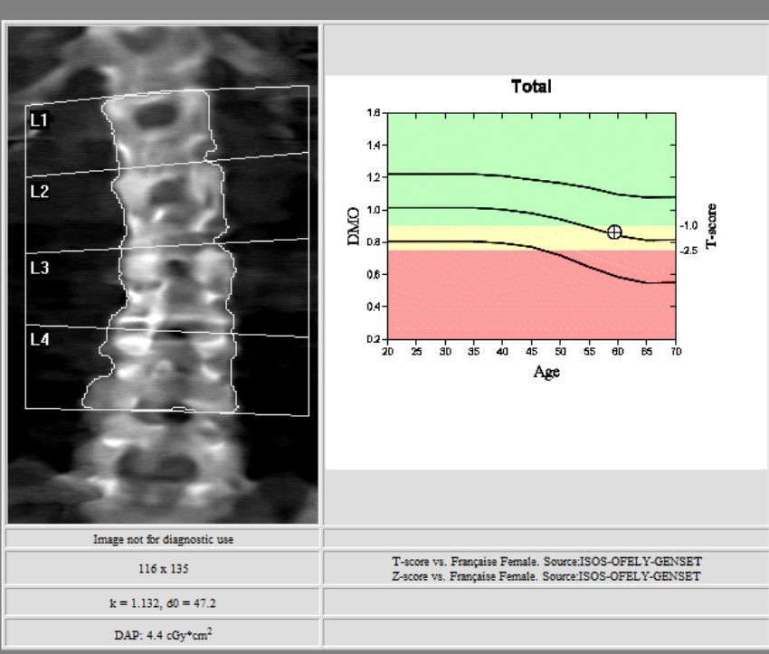  Ostéo densitométrie images d'examen