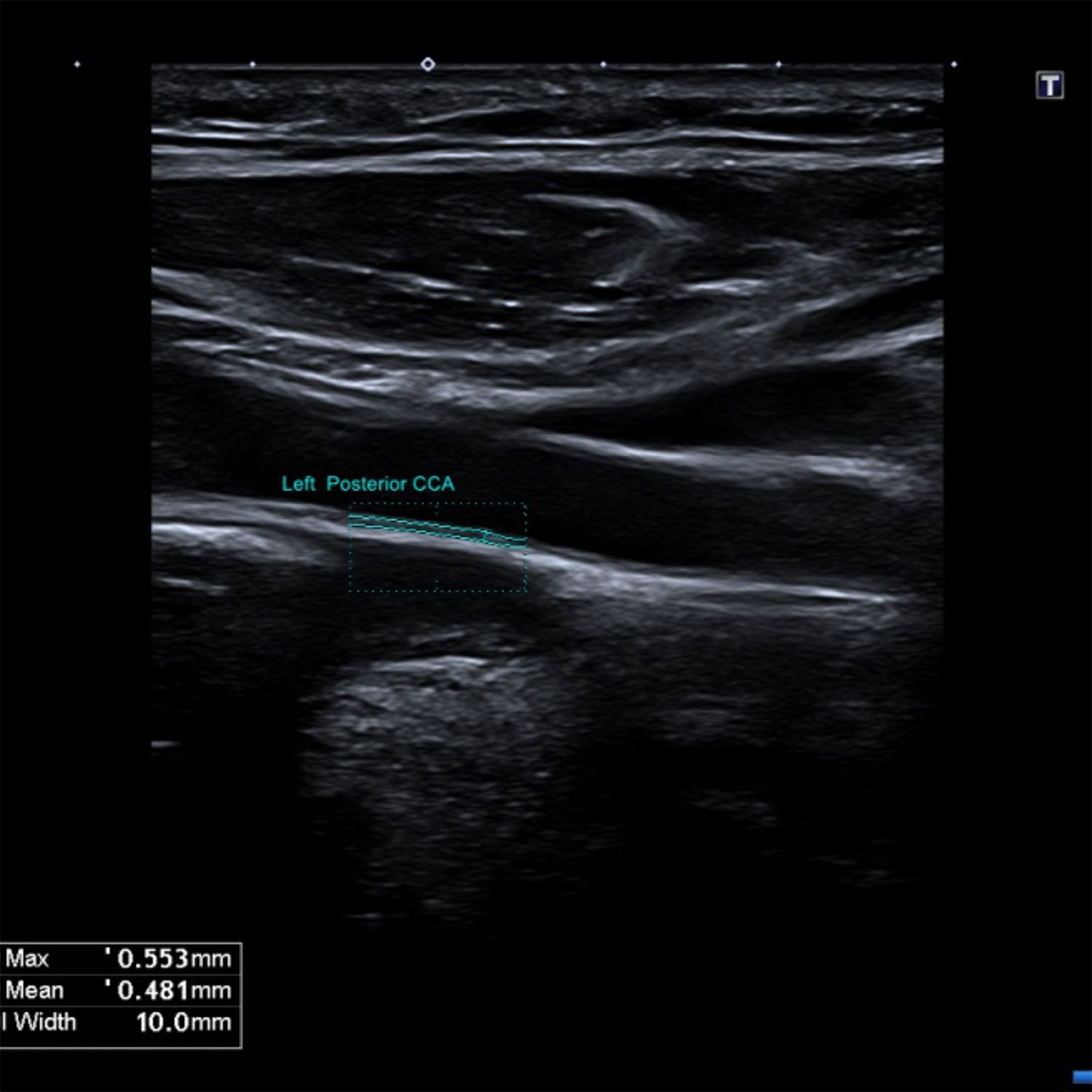 Doppler veineux et artériel images d'examen
