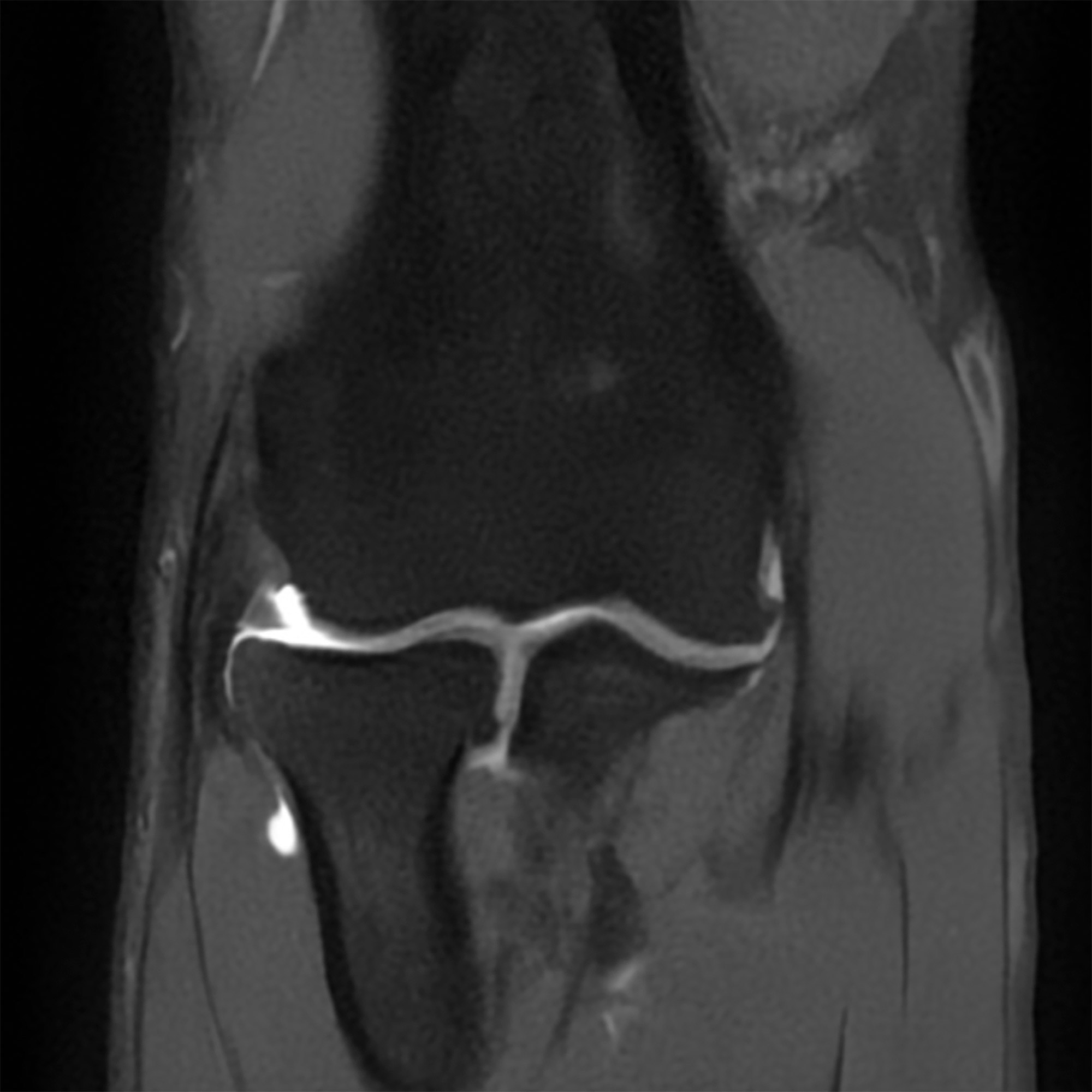 Arthro-IRM images d'examen