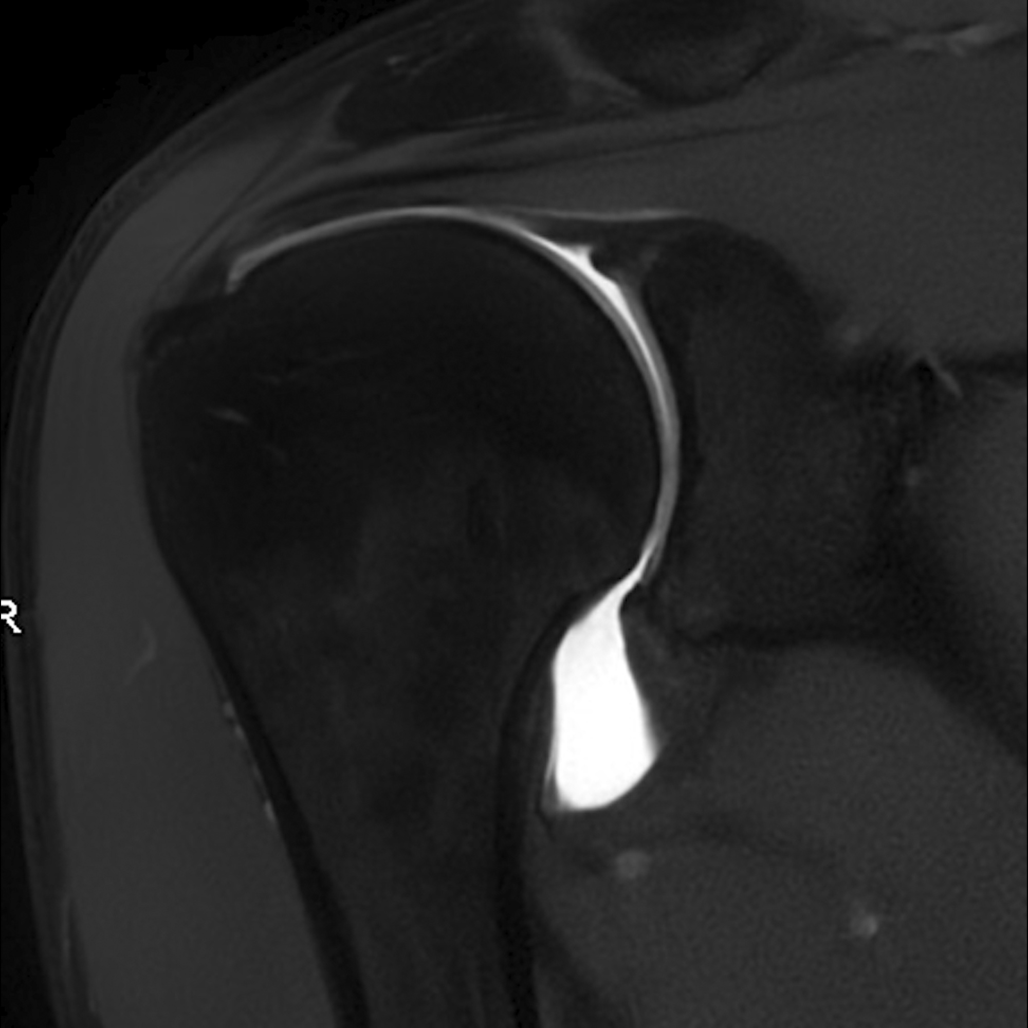 Arthro-IRM images d'examen