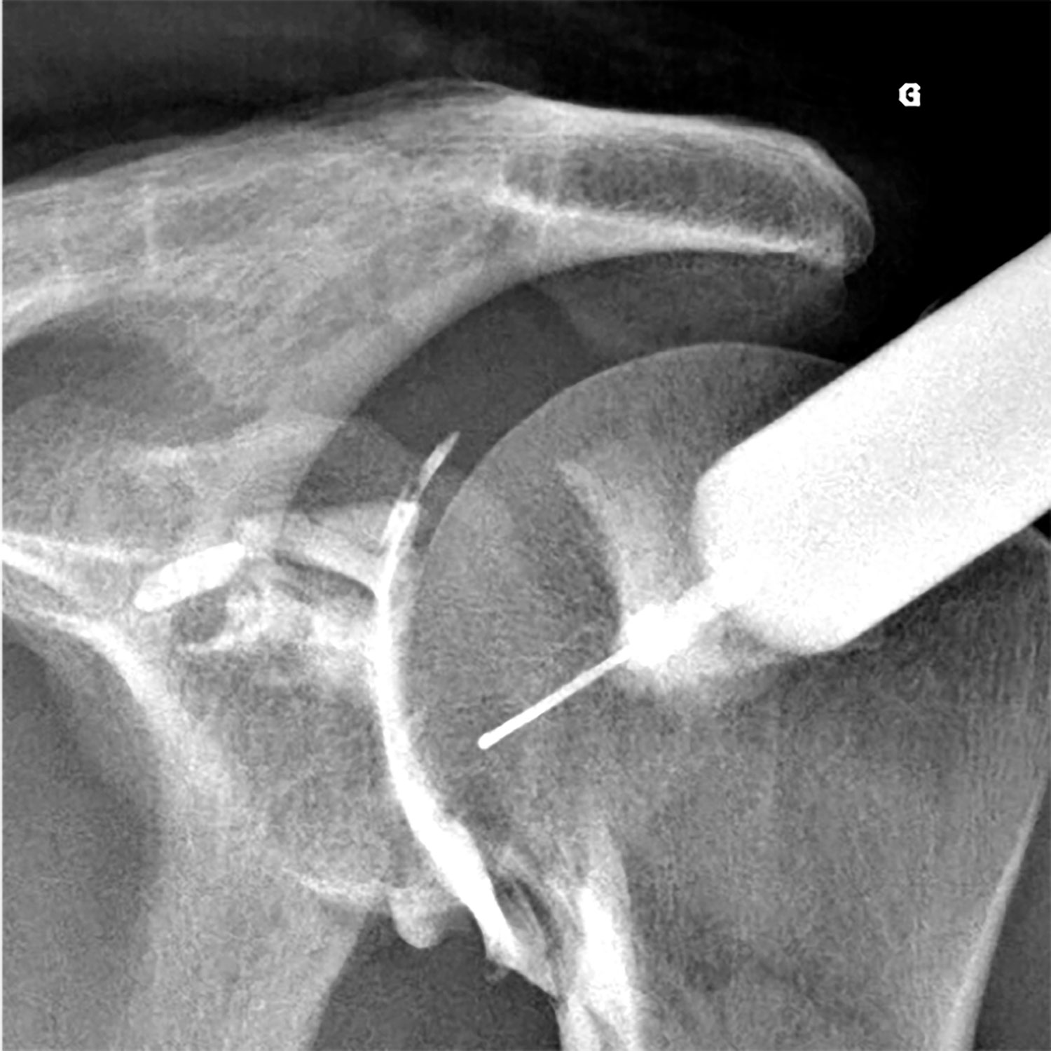  Infiltrations images d'examen