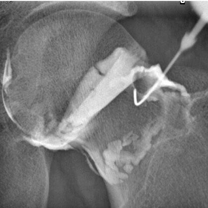  Infiltrations images d'examen